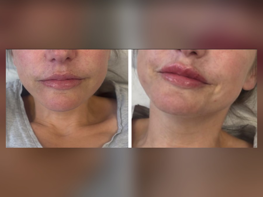 Lip enhancement before and after result