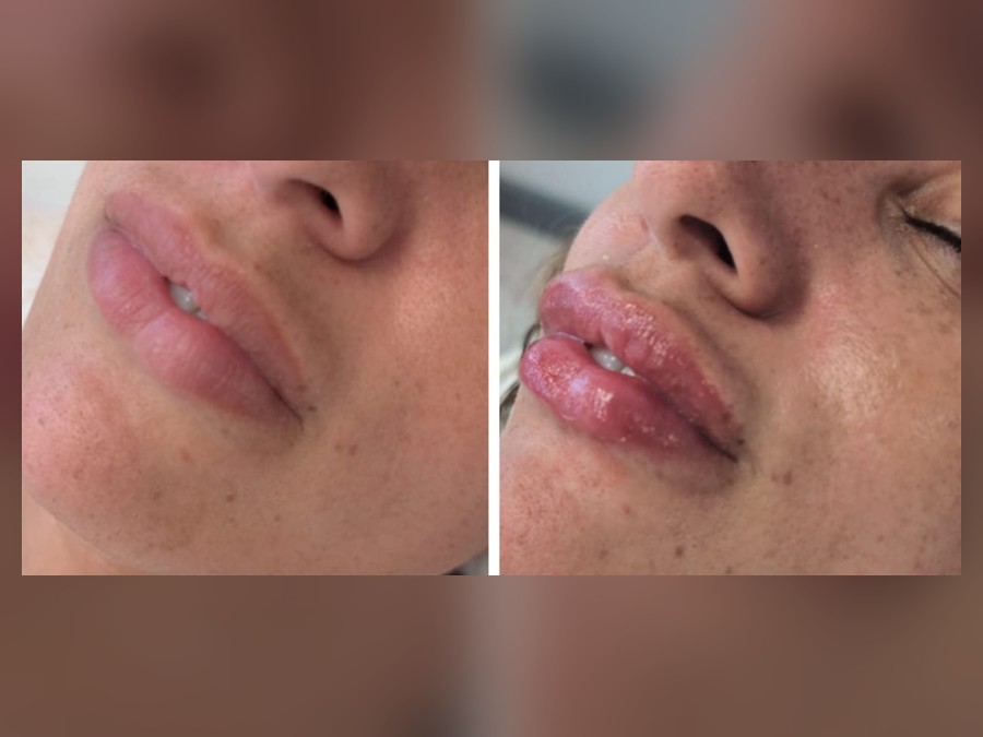 Close-up lip enhancement before and after result